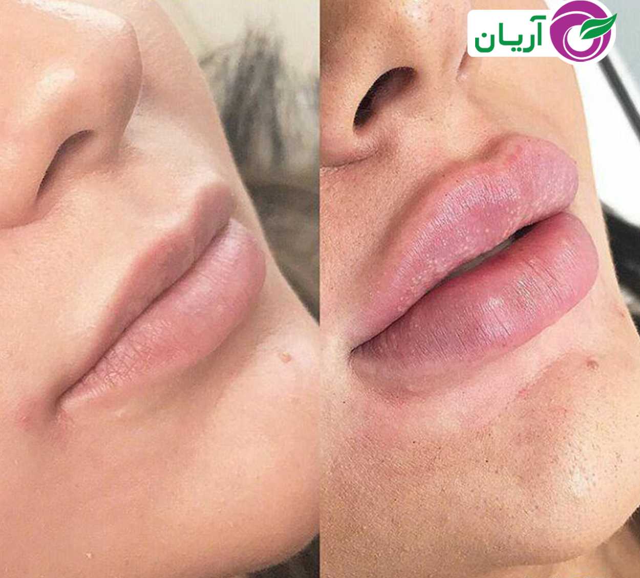 تصاویر قبل و بعد از تزریق ژل